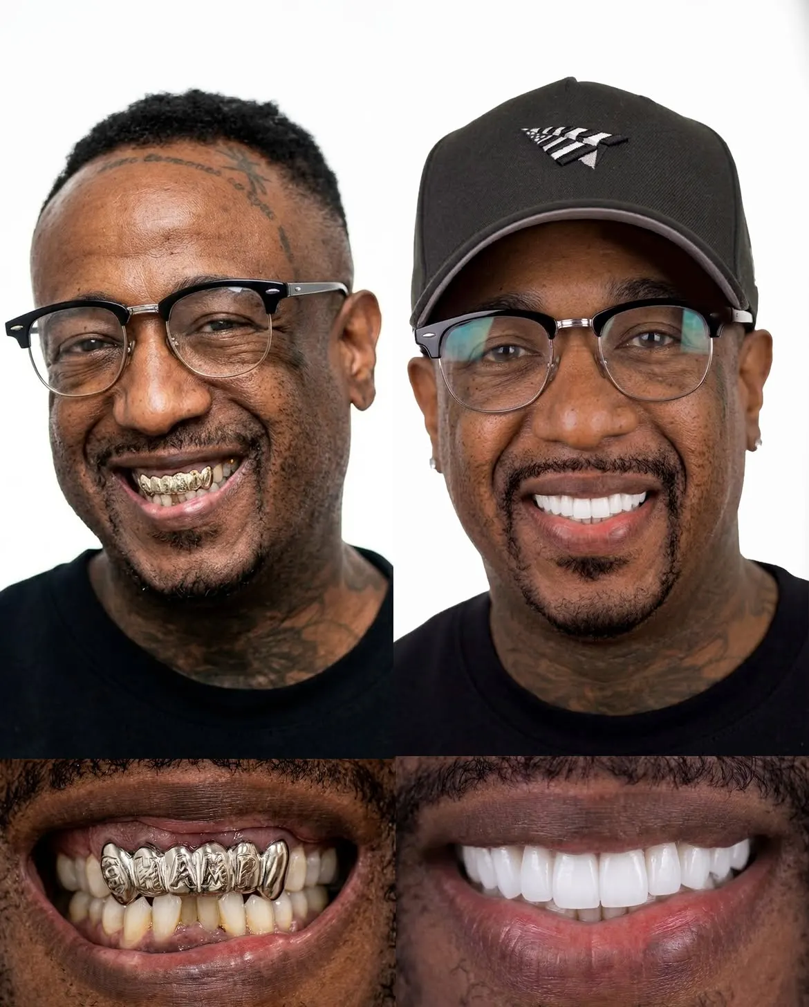 Before and after porcelain veneers, Xiluet patient, Miami