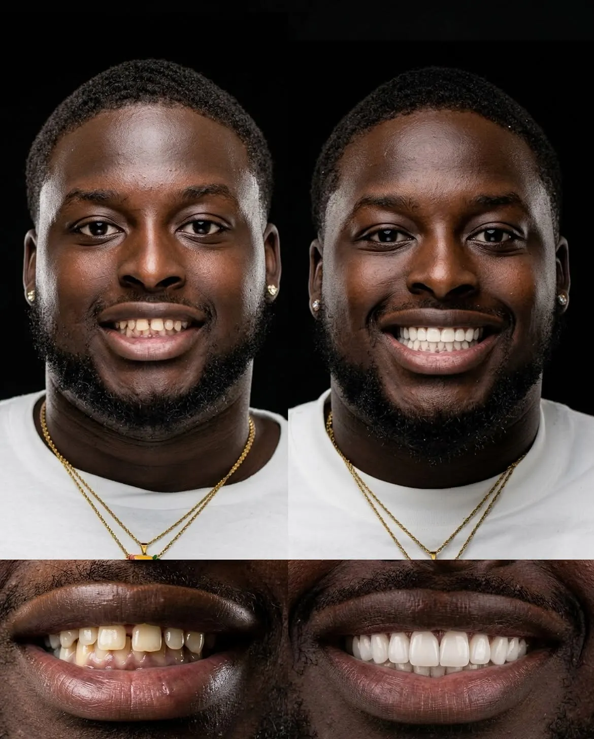 Before and after porcelain veneers, Xiluet patient, Miami